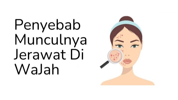 Jasa Lainnya di Gaya Hidup - Cara mudah agar jerawat tidak muncul di wajah